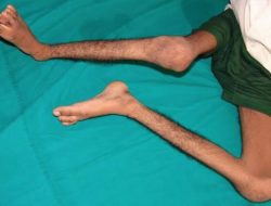 Hati-hati Polio Menyerang, dr Bahrani Ajak Masyarakat Kenali Gejala Polio