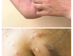 Serupa Namun Tak Sama, Simak Perbedaan Cacar Monyet dan Cacar Air